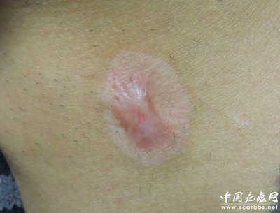 淺析放射性同位素敷貼治療方法_儀器修復_疤痕修復_中國疤痕網(wǎng) - 您身邊的疤痕修復專家